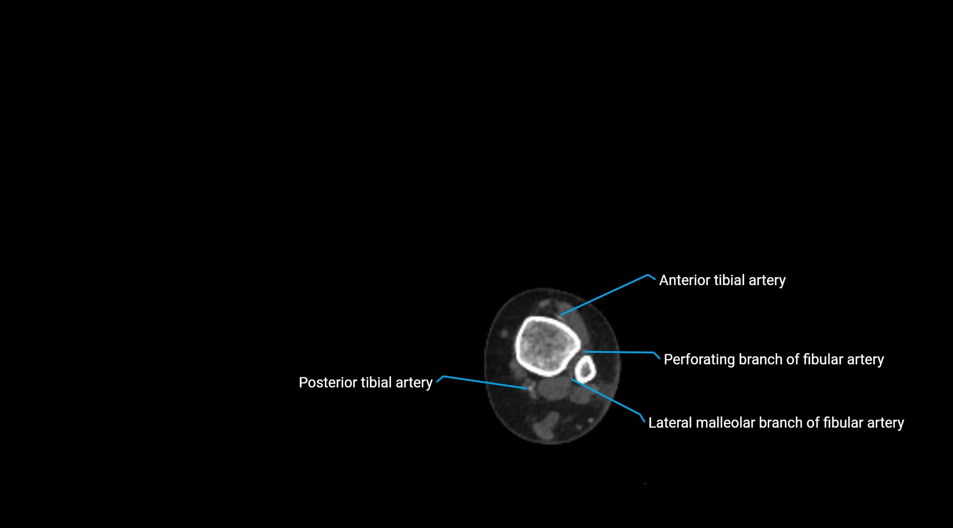 CTA lower limb cross sectional anatomy labelled image _266.webp